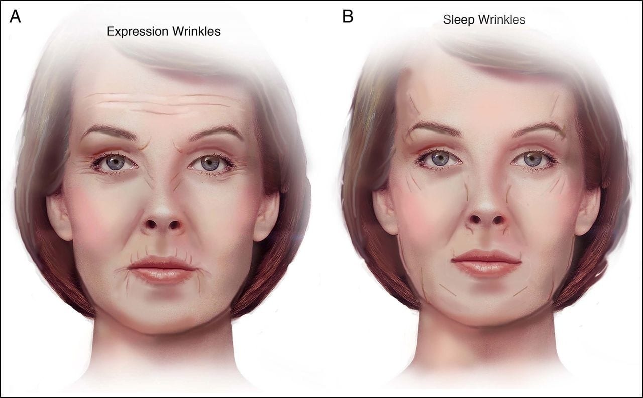 expression wrinkles vs. sleep wrinkles