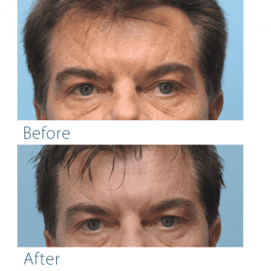 Before-and-after fillers for sleep lines