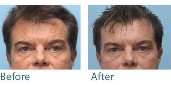 before and after male treatment for side sleeping wrinkles