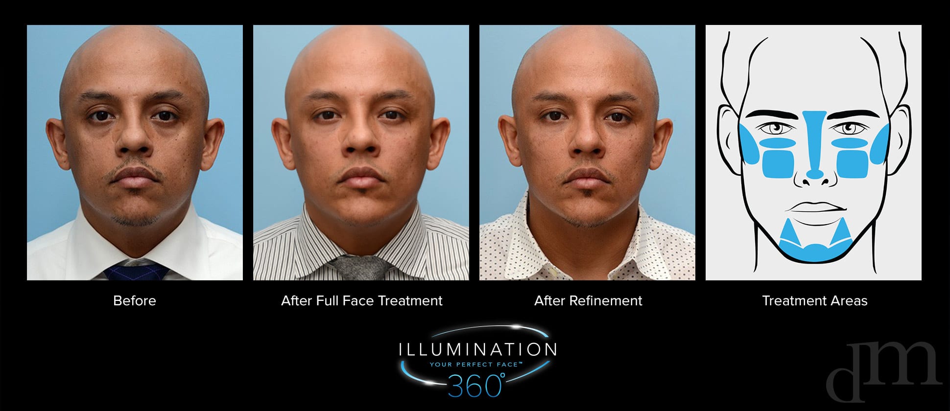 male before, after full face treatment, after refinement, treatment areas