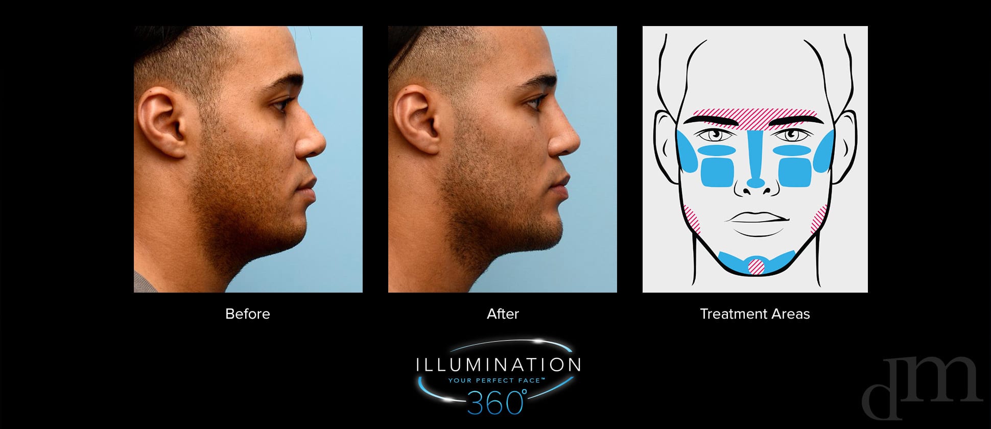 male before and after cheeks and chin fillers