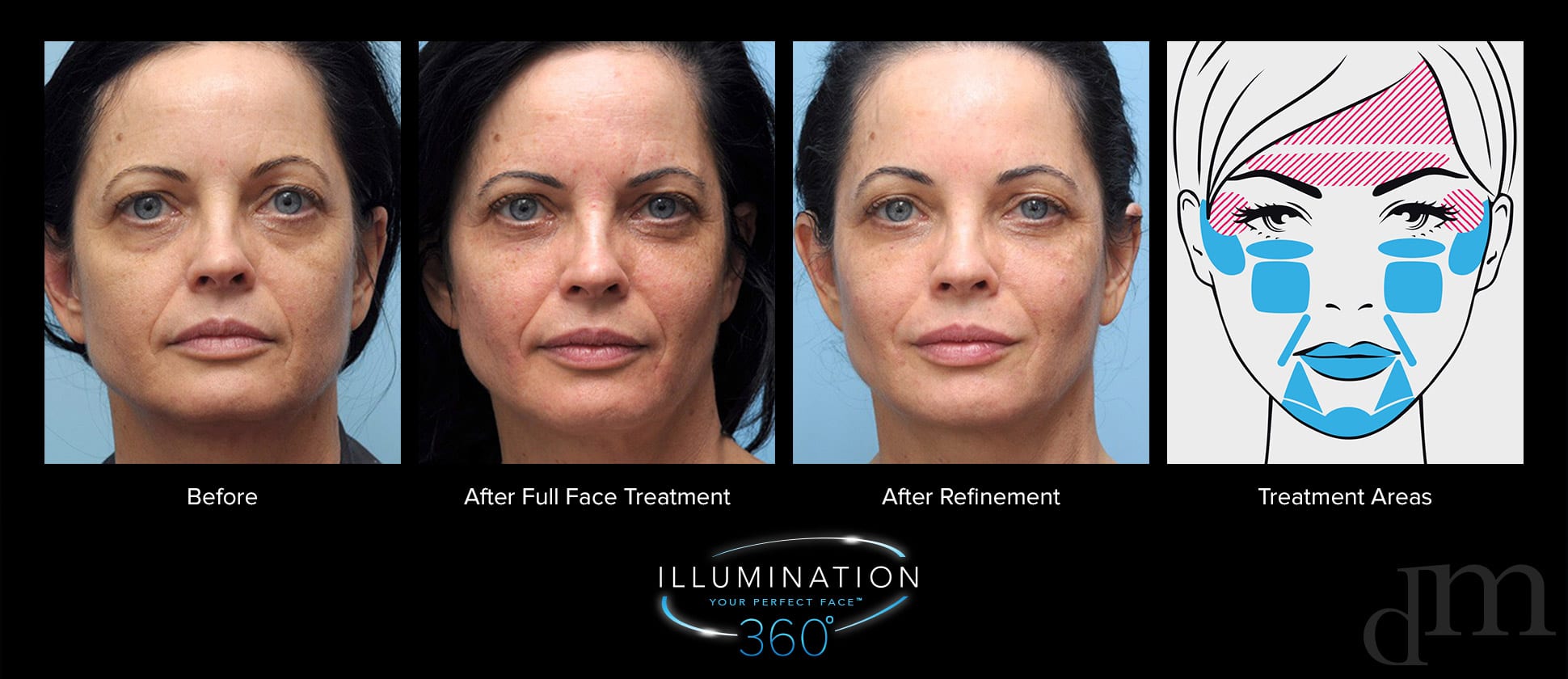 Middle aged woman before and after full face treatment, after refinement treatment, and diagram of treatment areas.