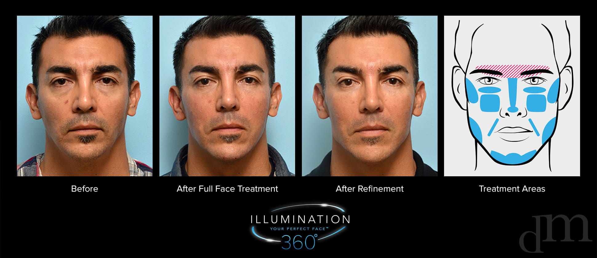 male before, after full face treatment, after refinement, treatment areas