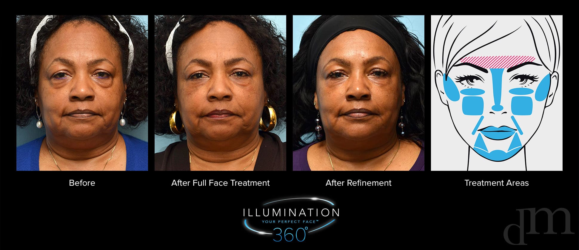 Older woman before and after full face treatment, after refinement treatment, and diagram of treatment areas.