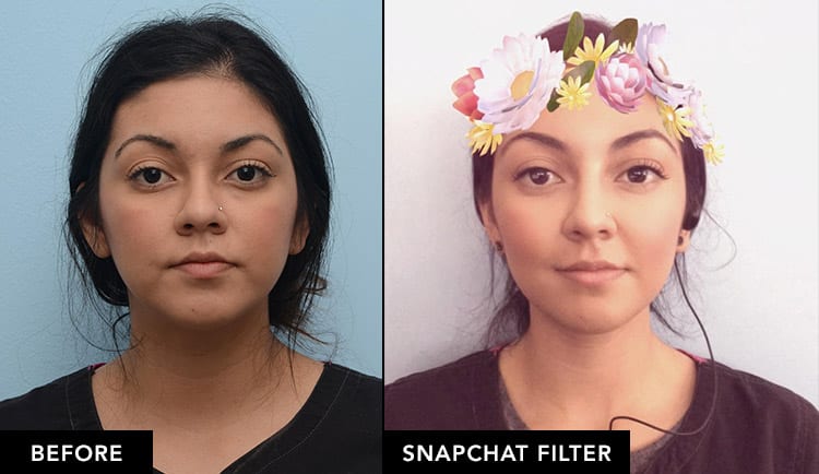 Dermal Fillers Botox Vs Snapchat Filters In The San Francisco Bay Area David Mabrie M D Mabrie Facial Institute