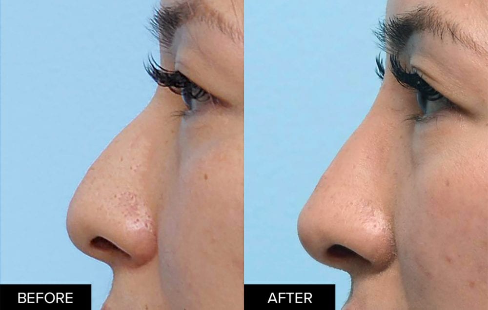 Eileen nonsurgical rhinoplasty before and after profile