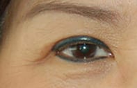 Blanca's eye's after surgery