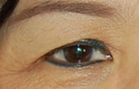 Blanca's eye's before surgery
