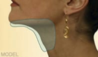 Area under chin that can be improved with facial liposuction