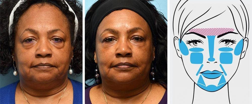 Full face treatment example on a woman