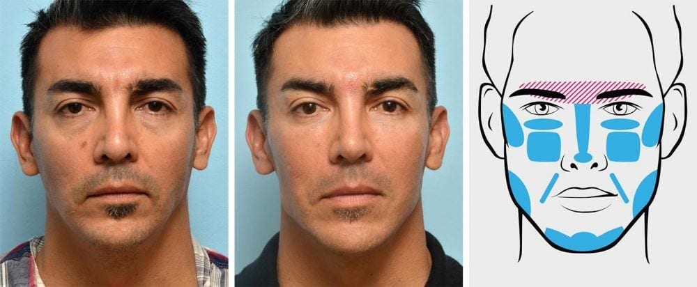 Full face treatment example on a man