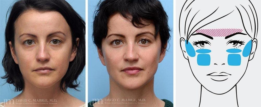 Upper face foundation treatment example on a woman