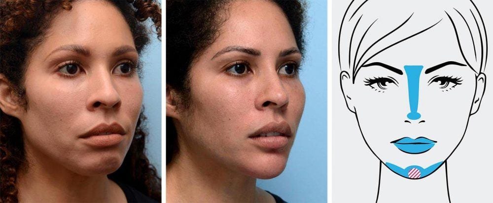 Lower face foundation treatment example on a woman