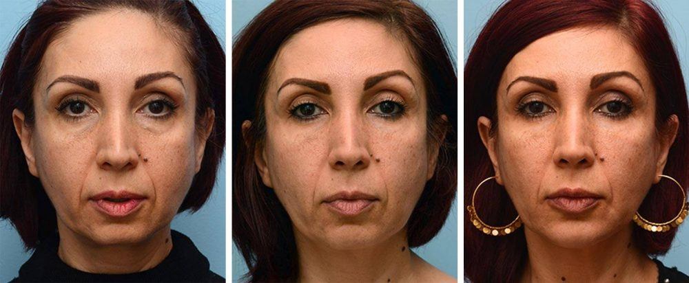 Before, After Full-Face Treatment, After Refinement Treatment