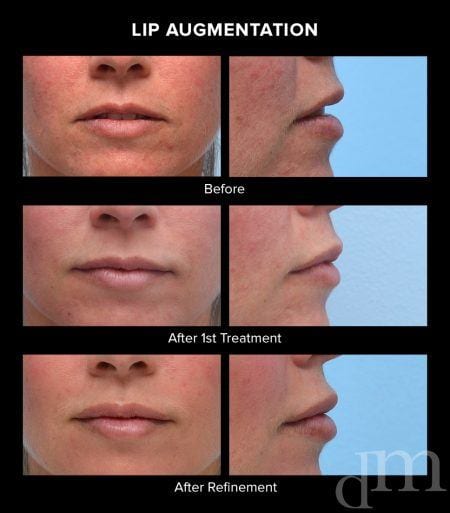 Lip Augmentation Before and After Treatment