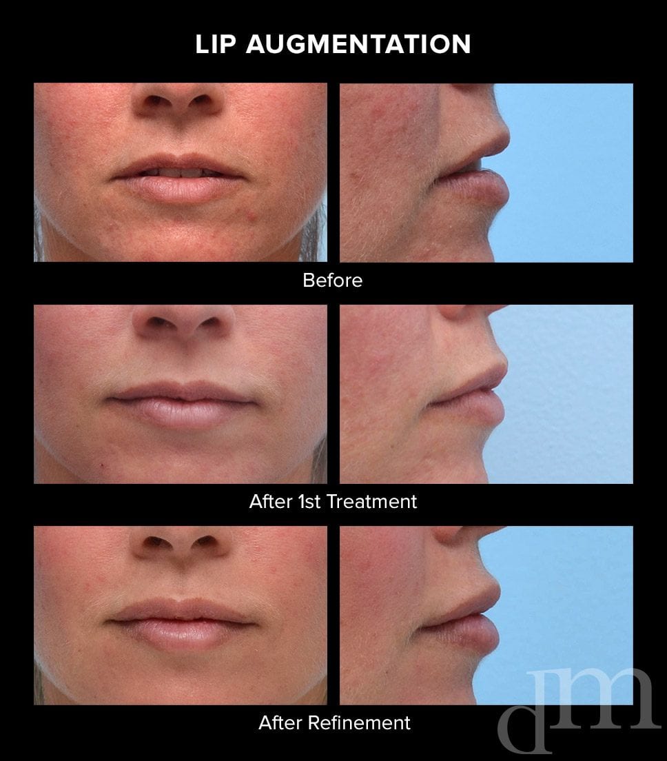 Lip Augmentation Before and After Treatment