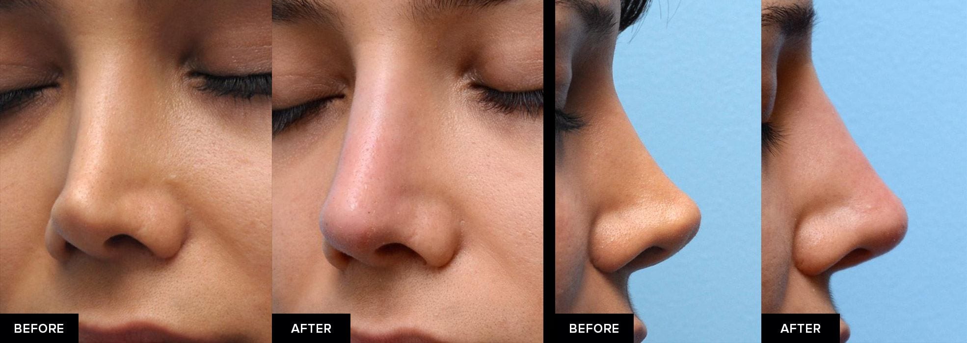 non surgical nose job after rhinoplasty before and after