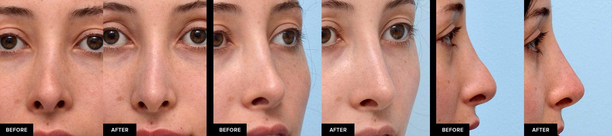 before and after nose fillers after surgical rhinoplasty