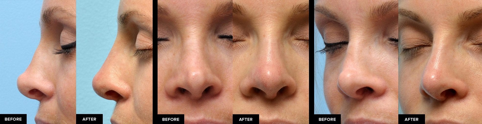 before and after nose fillers after surgical rhinoplasty