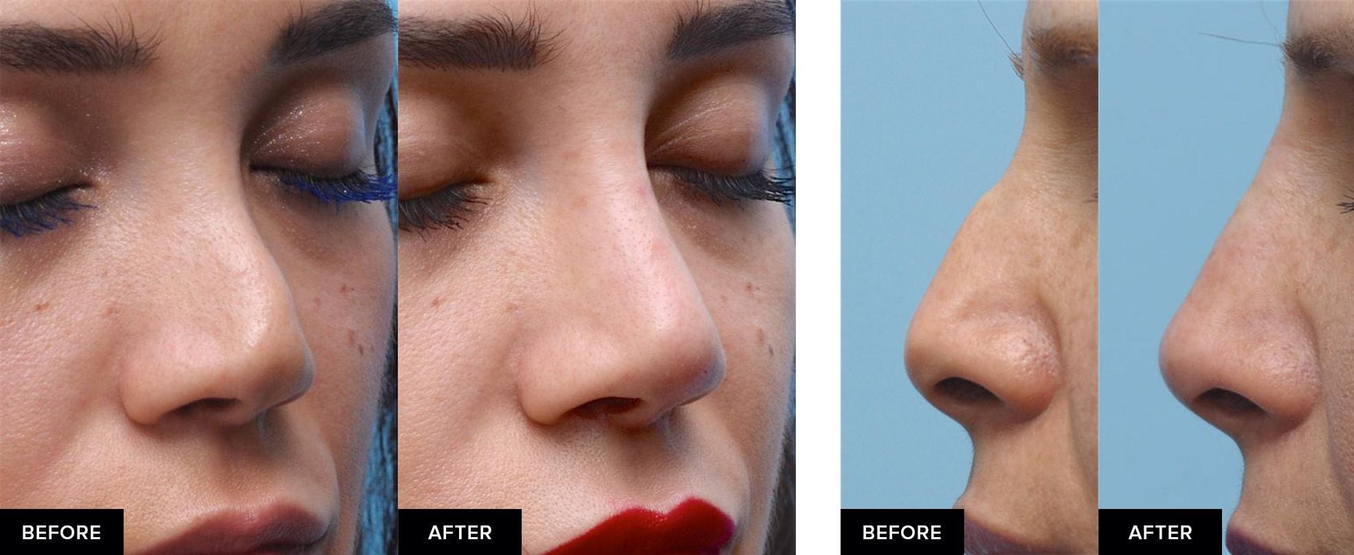 before and after nose fillers after surgical rhinoplasty