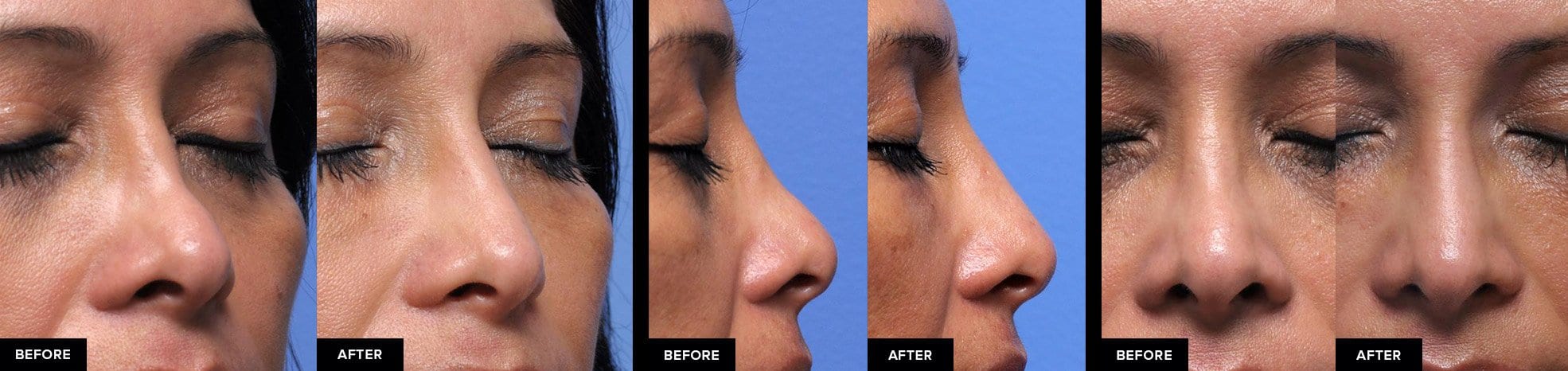 before and after nose fillers after surgical rhinoplasty