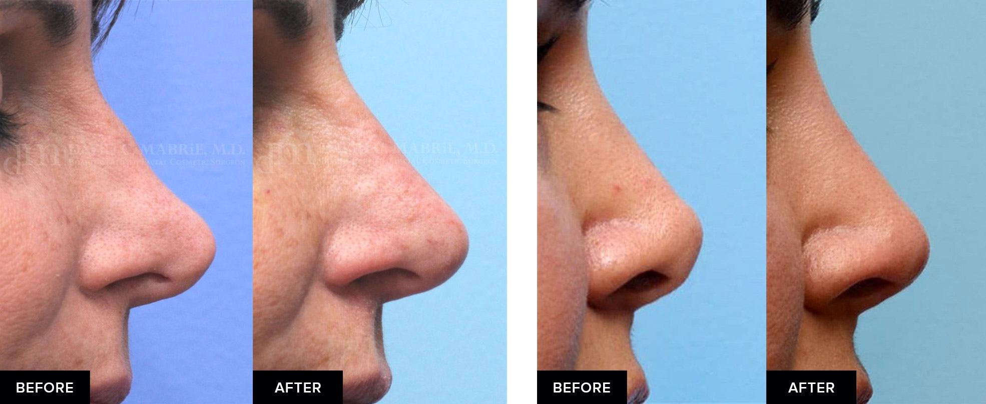 before and after nose fillers after surgical rhinoplasty