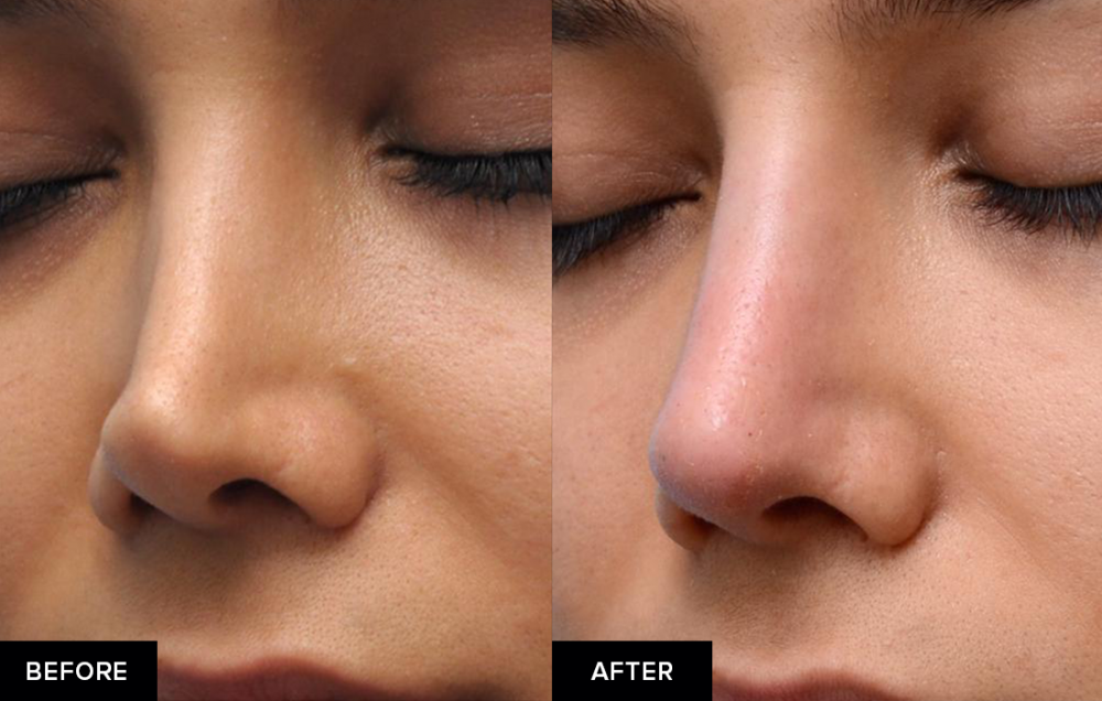 non surgical nose job after rhinoplasty before and after