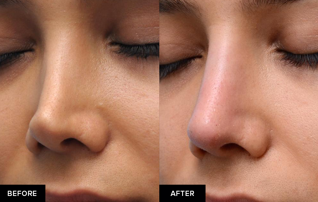 Female before and after nose fillers after surgical rhinoplasty. 