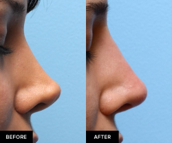 non surgical nose job after rhinoplasty before and after