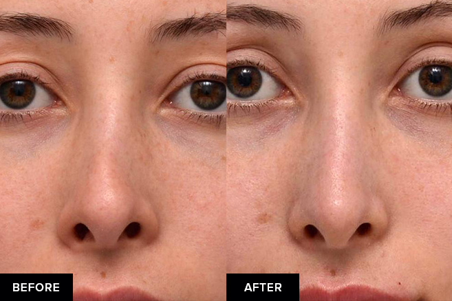 before and after nose fillers after surgical rhinoplasty
