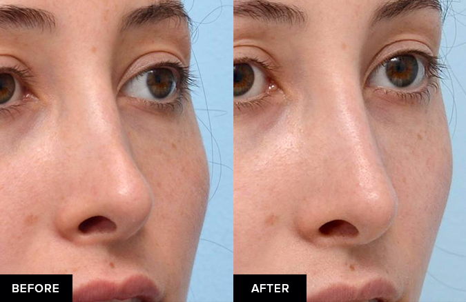 before and after nose fillers after surgical rhinoplasty