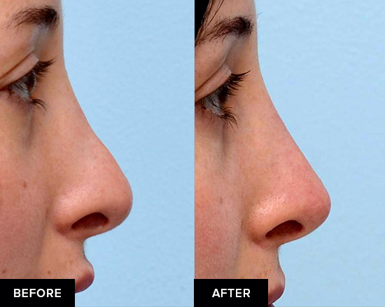 before and after nose fillers after surgical rhinoplasty