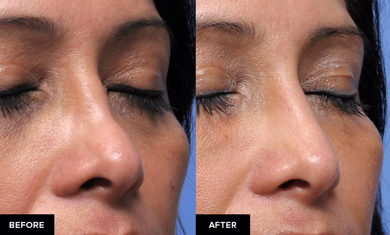 before and after nose fillers after surgical rhinoplasty