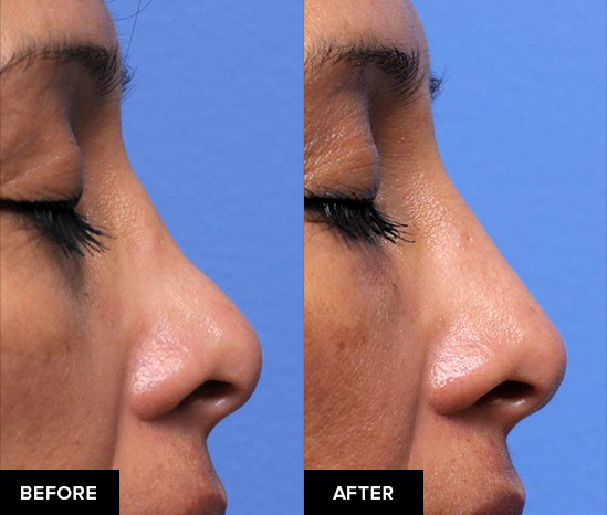 before and after nose fillers after surgical rhinoplasty