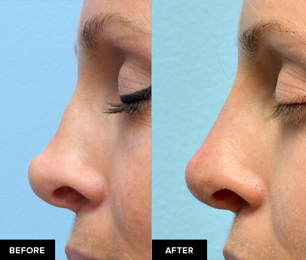 before and after nose fillers after surgical rhinoplasty