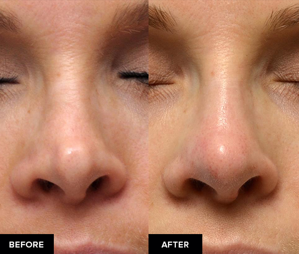 before and after nose fillers after surgical rhinoplasty