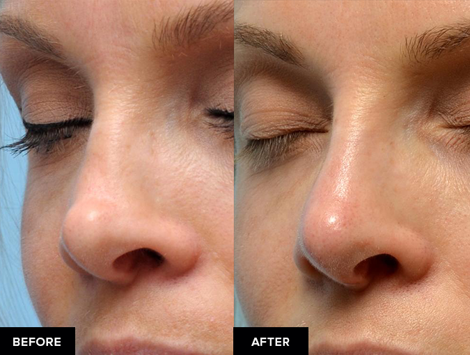 before and after nose fillers after surgical rhinoplasty