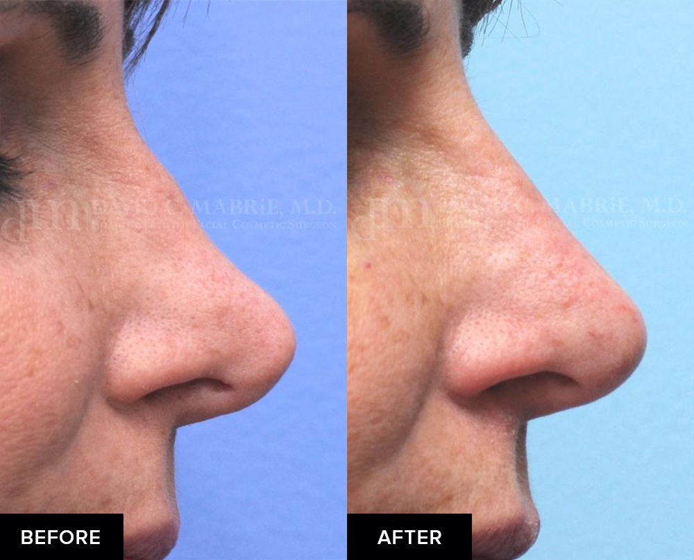 before and after fillers after rhinoplasty