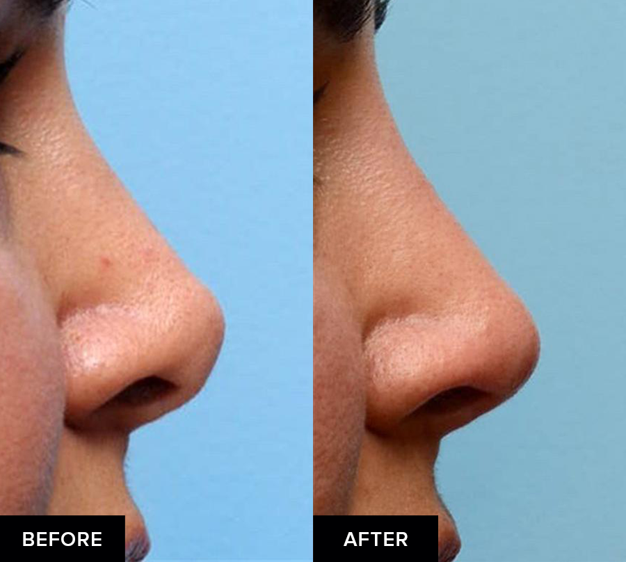before and after fillers after rhinoplasty