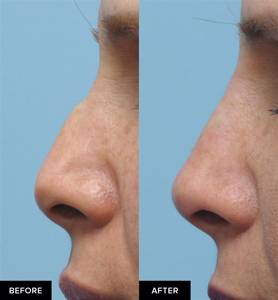 before and after nose fillers after surgical rhinoplasty