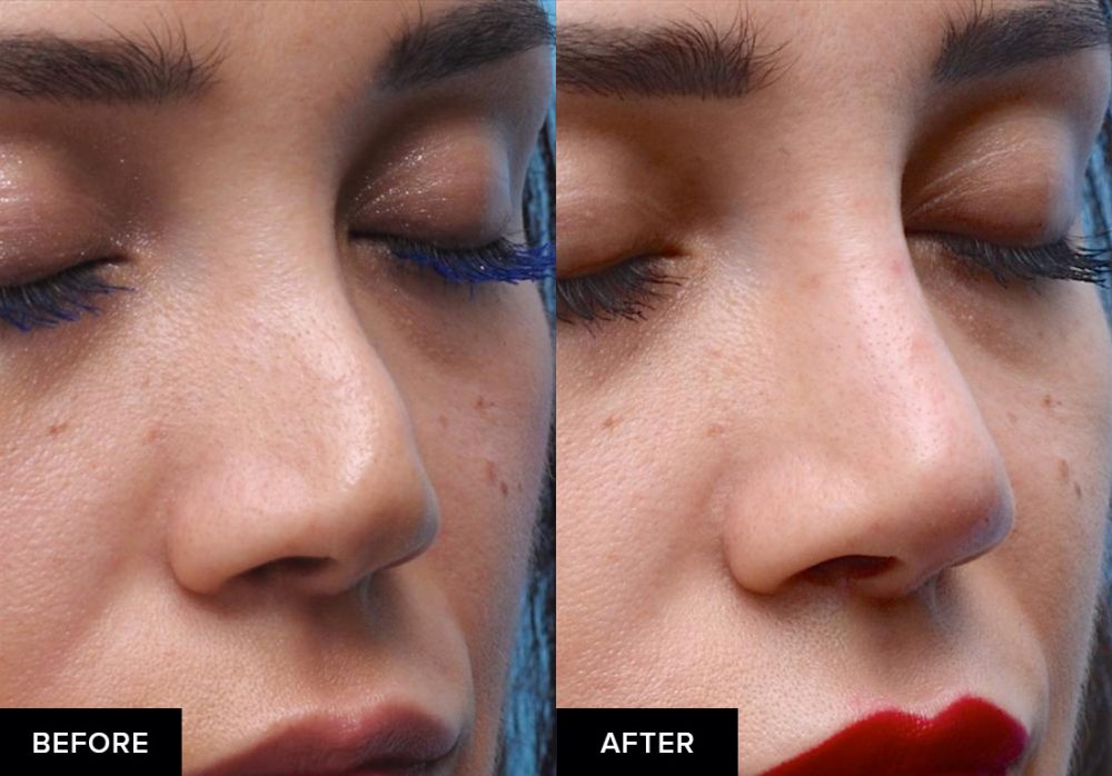 before and after nose fillers after surgical rhinoplasty