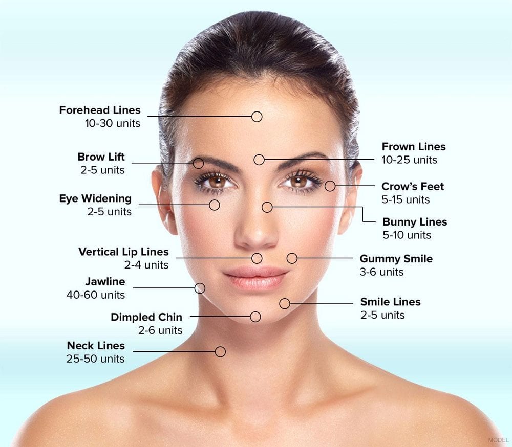 Units of Botox needed for each location of the face