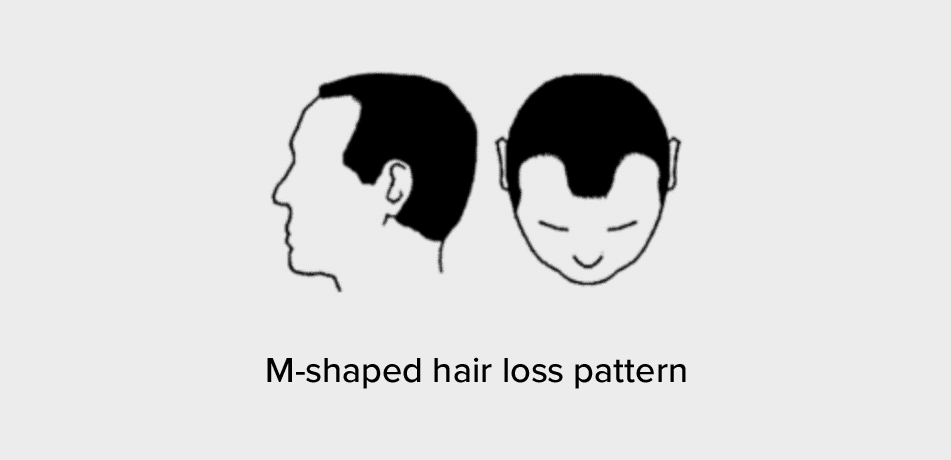 Hair loss style