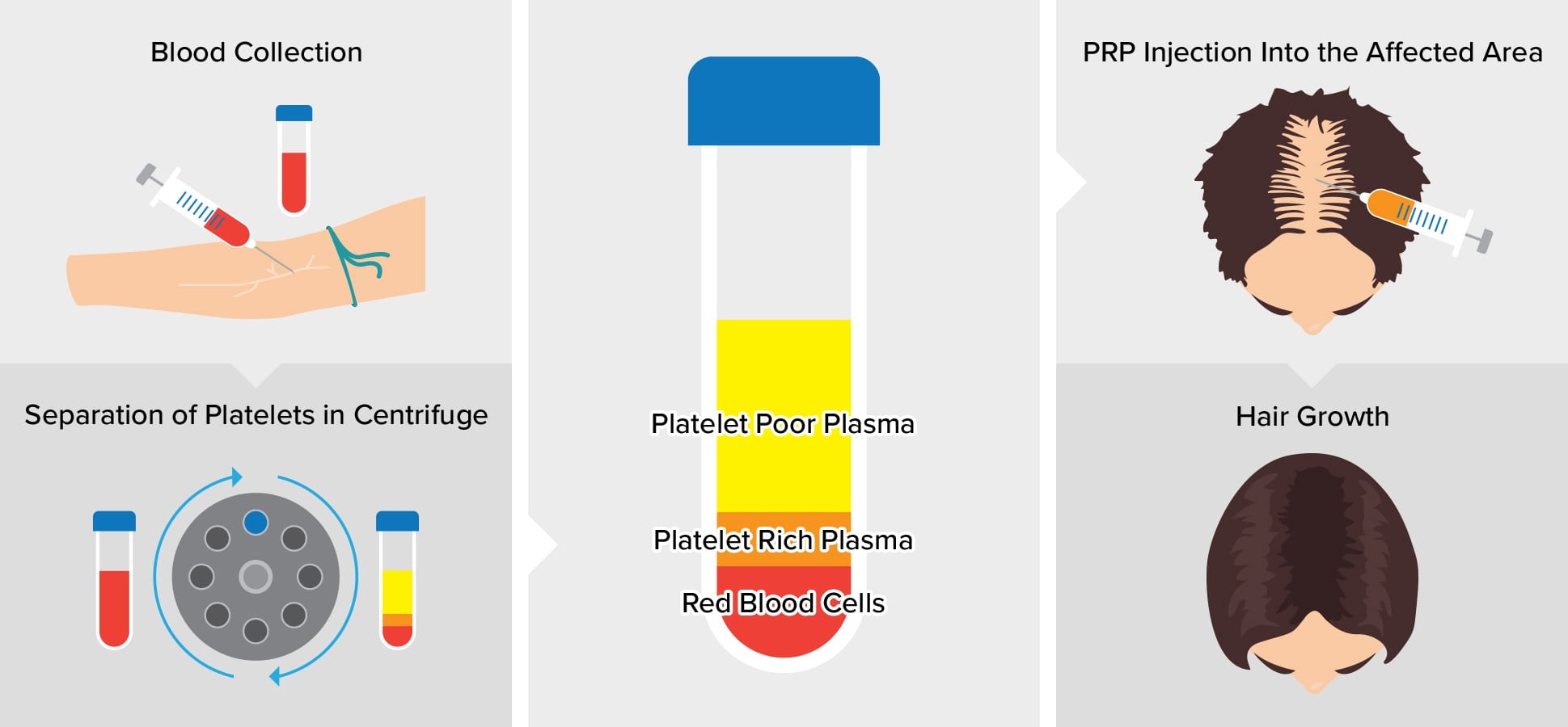 Blood collection, separation of platelets in centrifuge, platelet rich plasma separated from platelet poor plasma and red blood cells, PRP injection into affected area, hair growth