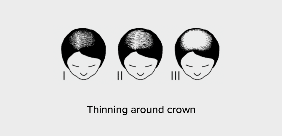 Hair loss style