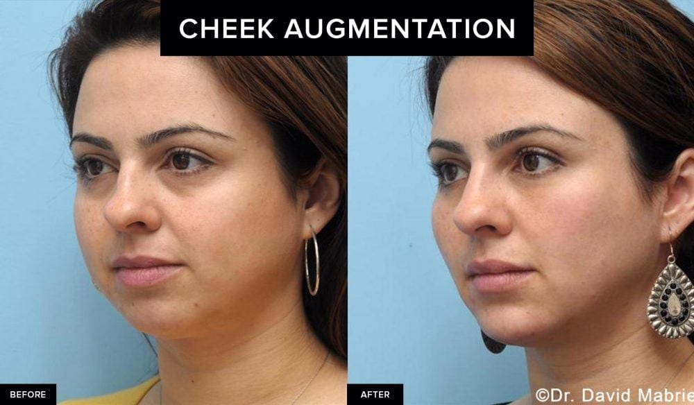 before and after female cheek augmentation
