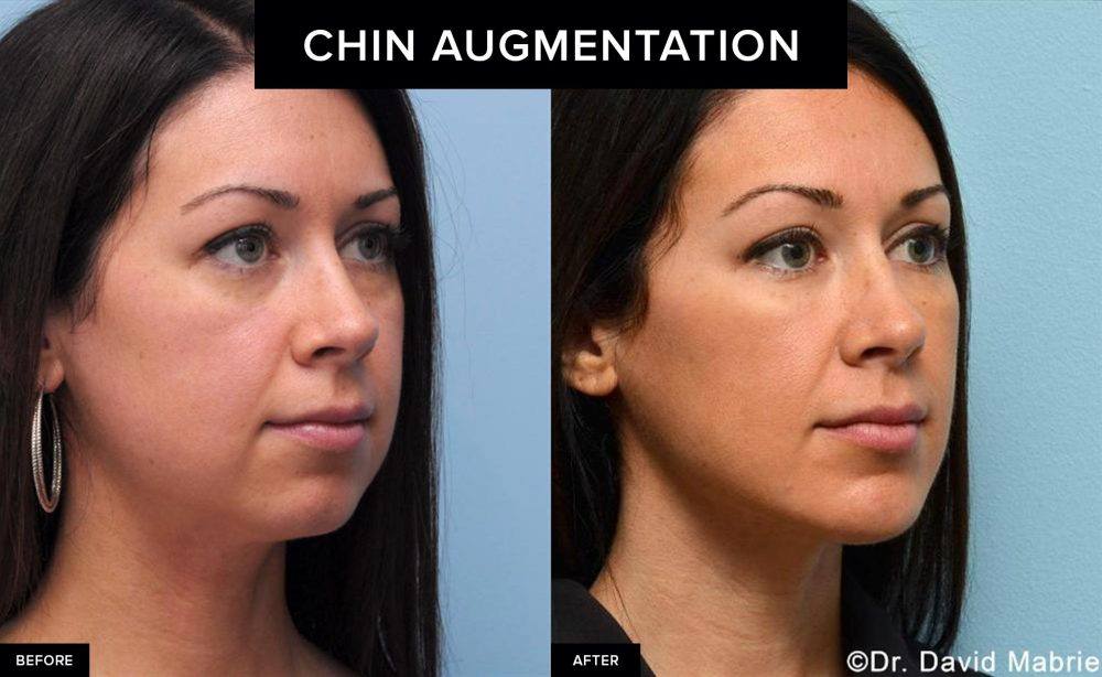 before and after female chin augmentation