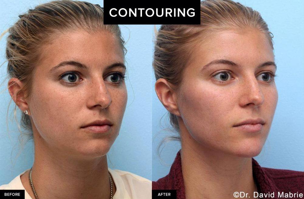 before and after female contouring