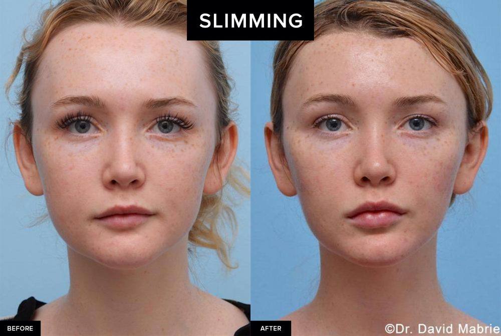 before and after female slimming
