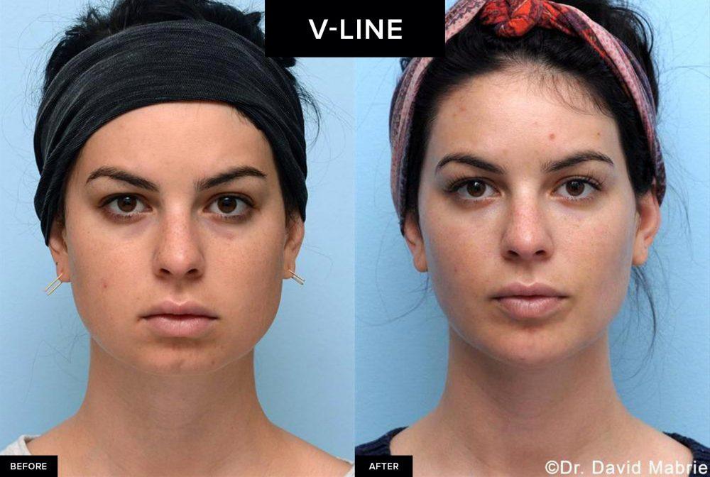 before and after female v-line